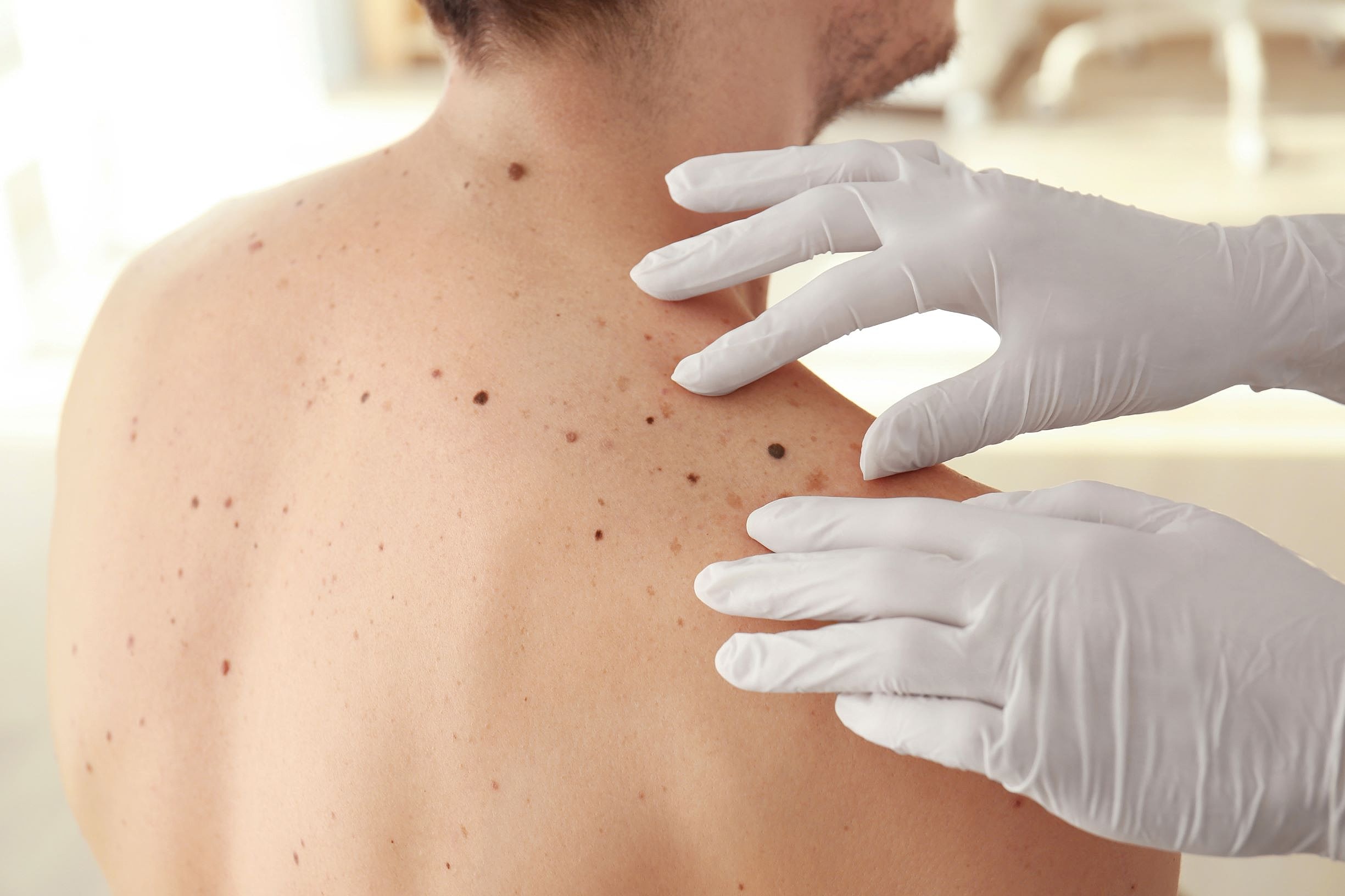 Dermatologist examining skin moles on patient.